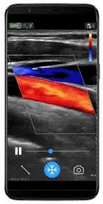 Carotid artery using V Scan Air